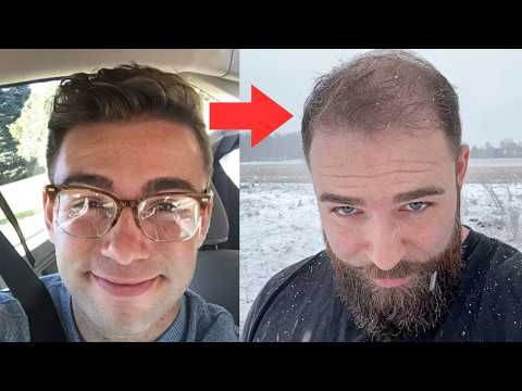 My Balding Journey Has Come To An End