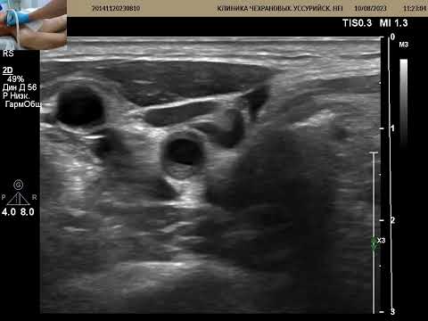 УЗИ БЦА . Как ставить датчик? Что такое ECST & NASCET?