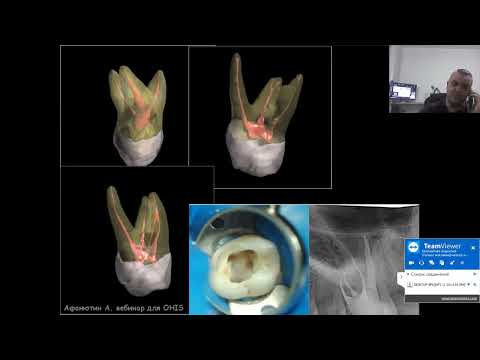 Вебинар №3 - Частная анатомия корневых каналов.