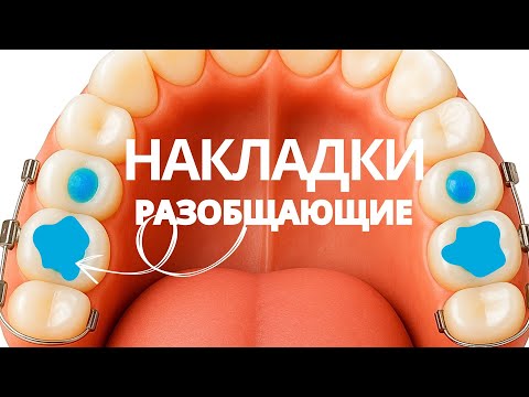 PADS with braces | The worst thing about orthodontics