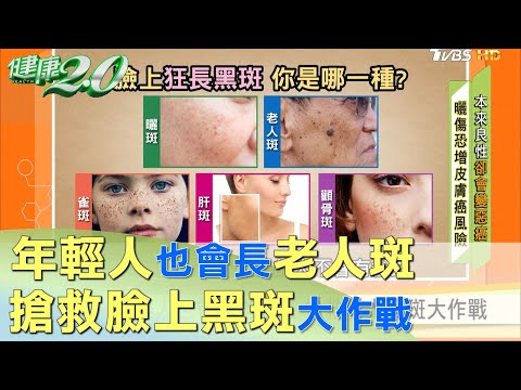 年輕人也會長老人斑 搶救臉上黑斑大作戰 健康2.0