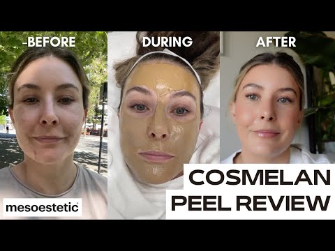 COSMELAN DEPIGMENTATION PEEL | chemical peel for pigmentation + dark spots