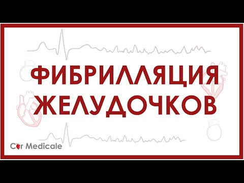 Фибрилляция желудочков