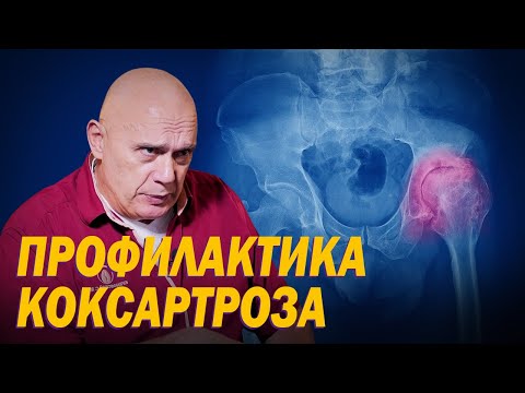 Что такое коксартроз и как подготовиться к эндопротезированию? Профилактика суставных заболеваний