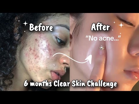 Get Clear Skin in 6 Months : No more Acne !! ✨💦