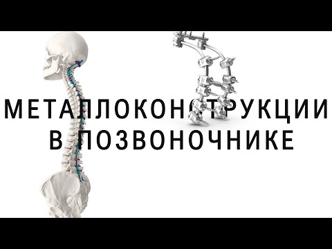 Spinal surgery with metal braces! My personal opinion.