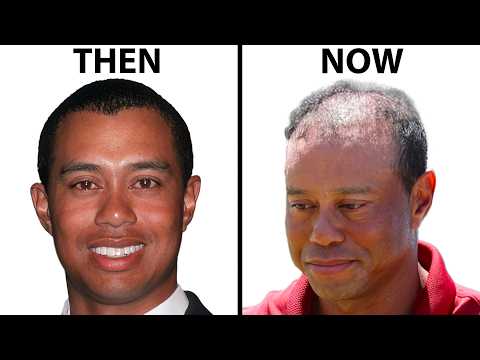 Tiger Woods Hair Transplant | Plastic Surgery Analysis