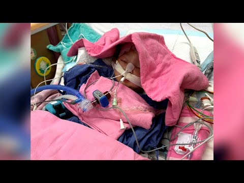 九個月女嬰疑被社區保姆虐待昏迷 母親對女兒康復感到徬徨及無助