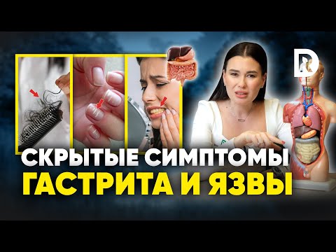 5 скрытых СИМПТОМА гастрита, язвы и панкреатита. Как распознать ЗАБОЛЕВАНИЯ ЖКТ