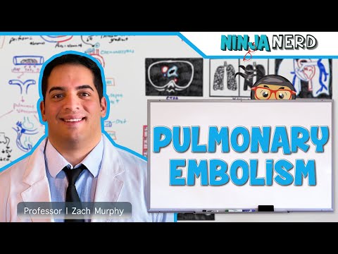 Pulmonary Embolism | Etiology, Pathophysiology, Clinical Features, Diagnosis, Treatment | Retired