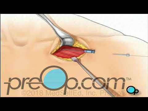 Permanent Pacemaker Implant Surgery - PreOp®  Patient Education