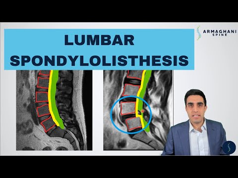 Lumbar Spondylolisthesis - Anatomy, Symptoms, Causes, Treatments and more!