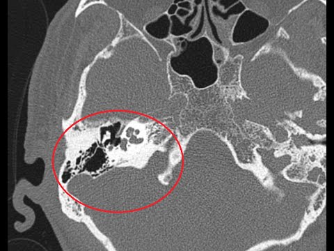 HRCT Temporal bone | A more detailed version | Basic to Advanced : AXIAL & CORONAL         VERSION 2