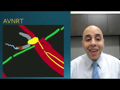 SVT - Supraventricular Tachycardia For Patients