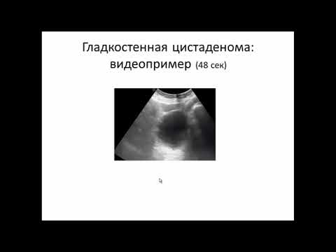 УЗИ опухолей яичников.Видеолекция