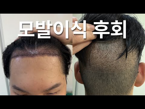 모발이식 5일 차, 솔직히 후회됩니다.