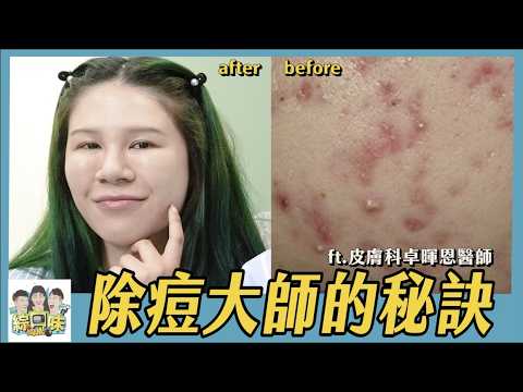 【綜口味】痘痘、粉刺一直治不好？醫師曝5大日常NG行為：90%人都不知道！#綜口味開房間 EP.850