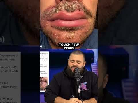 New monkeypox just dropped