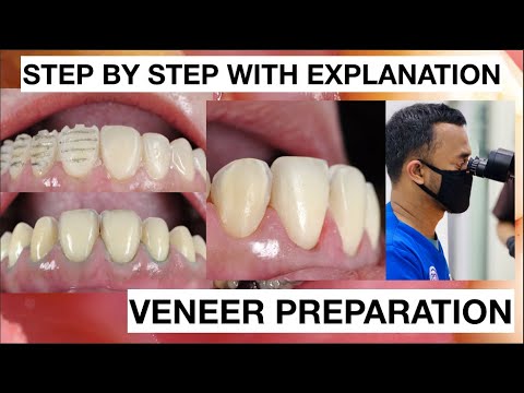 Step by Step Minimally Invasive Veneers Preparation | General Dentist Griya RR
