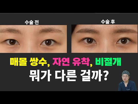 (온라인성형상담)매몰로 첫 쌍수, 재수술 사례 보며 비절개와 자연유착 그리고 풀림까지.그 전부를 알아 보자