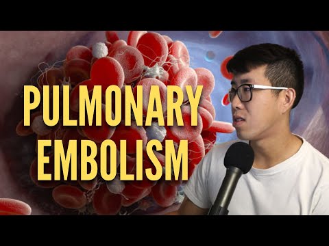 DVT/PE - What I Teach