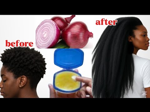 How To Use Vaseline And Onion To Grow Hair 2 cm Per Day Very Fast!!