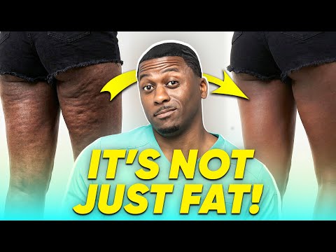 The REAL Cause of Cellulite (Nobody Is Talking About This!!)
