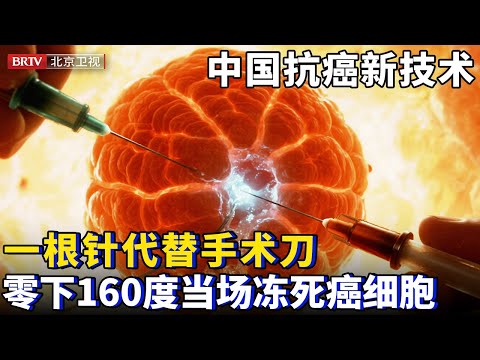 中国抗癌新技术，一根针代替手术刀，零下160度低温杀癌，当场冻死肿瘤【为你喝彩】
