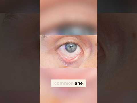 Can Dry Eyes Ruin Your Vision Surgery?