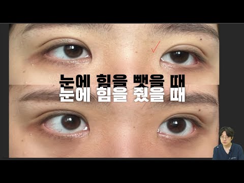 6년이나 참았습니다. 재수술 해야 될까요?