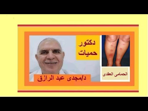 علاج مرض الحمامى العقدى | Erythema Nodosum treatment