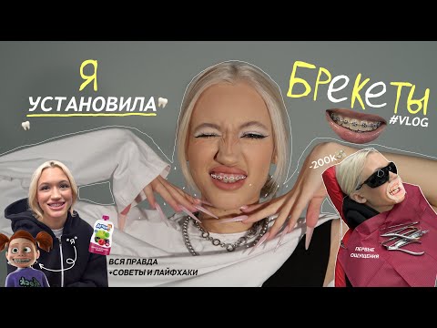 VLOG: Я ПОСТАВИЛА БРЕКЕТЫ! *первые ощущения* первый месяц с ними…