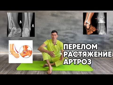 Разработка голеностопного сустава после снятия гипса.Можно делать при артрозе