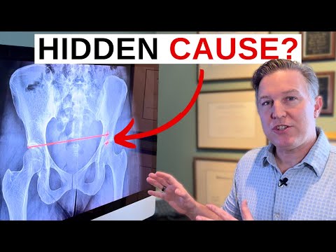 This Imbalance Can Lead To A Lifetime Of Back & SI Joint Pain