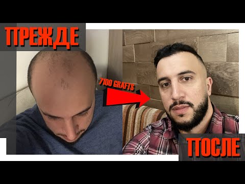 Пересадка волос (7100 графтов) Сбылась мечта длинною в 10 лет!!!