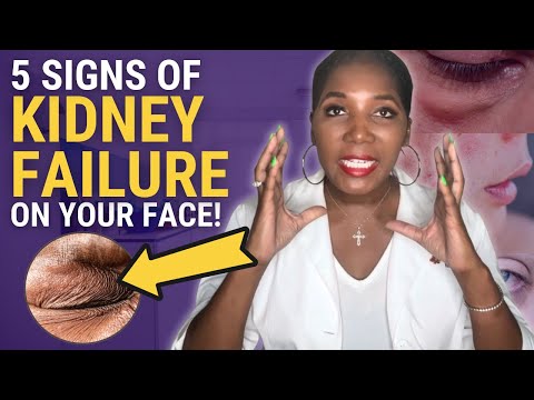 5 Warning Signs Of Kidney Disease Written On Your Face! Here's What You Should Know