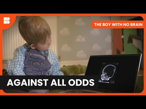 Born With 2% Brain, Now Defying Science | The Boy With No Brain