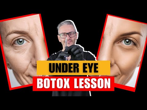Should you inject Botox under the eye? Under eye Botox Lesson
