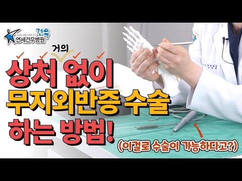 무지외반증 수술 이렇게 합니다(상처 걱정 X)