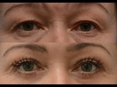 Complications after blepharoplasty: what should patients fear?