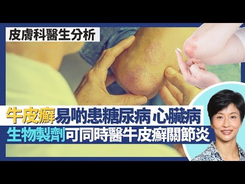牛皮癬｜銀屑病唔會傳染！牛皮癬患者易啲患糖尿病心臟病？部分生物製劑治療牛皮癬同時醫牛皮癬關節炎！｜王建芳醫生 皮膚科醫生陳厚毅醫生｜人類健康研究所
