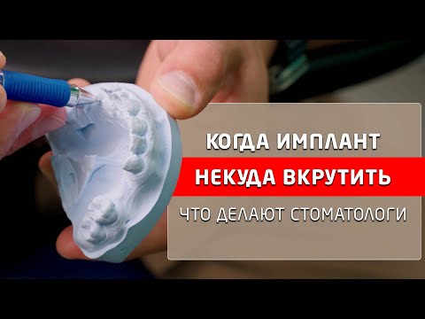 Костная пластика нижней челюсти и синус-лифтинг, зачем стоматологи делают это.
