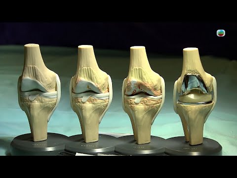 TVB最強生命線｜膝關節退化 (繁 / 簡字幕)｜醫療｜治療｜中醫｜無綫新聞｜TVB News