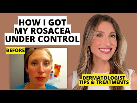 My Rosacea Journey: Dermatologist Shares Skincare & Treatments That Work! | Dr. Sam Ellis