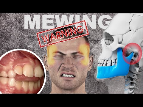 The Dangers of Mewing/Jawline Exercises