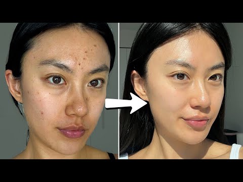 how I cleared my skin in a week with $0
