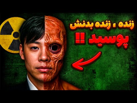 رادیواکتیوتر‌ین مرد تاریخ | "در حالی که زنده بود، شروع به پوسیدن کرد"