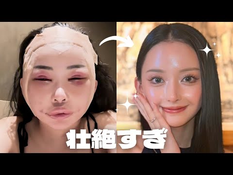 切開リフト眉骨アイホールボーン削りしてきた