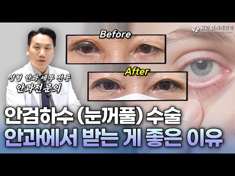 안검하수 수술, 성형외과보다 안과에서 해야 하는 결정적 이유