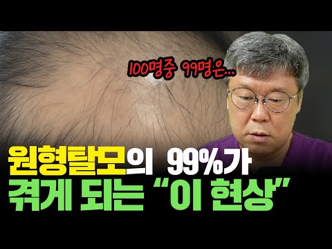 원형탈모인 사람이 겪게되는 실제 과정... ㄷㄷ 누구에게나 올 수 있습니다